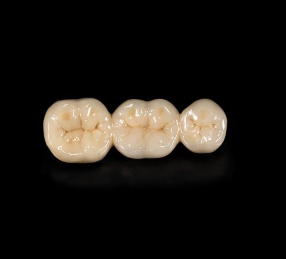 dental bridge greenville sc