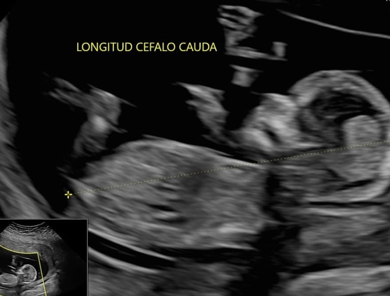 Ultrasonido primer trimestre, ultrasonido genético, ultrasonido cromosómico