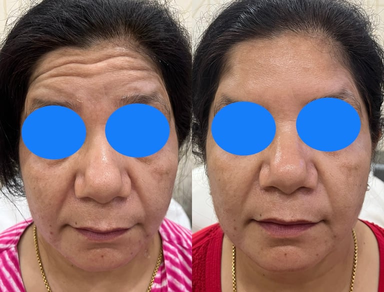woman with forehead lines after treatment with toxin