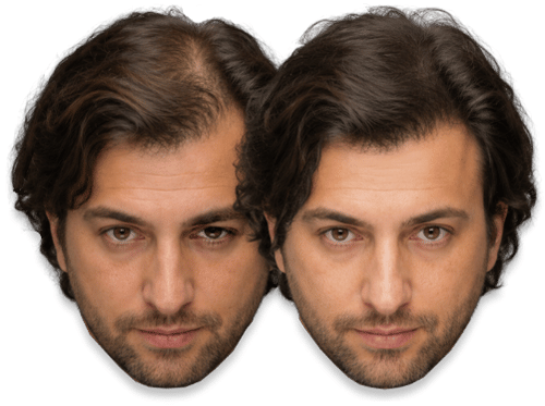 Before and after comparison of SMP treatment results on a man.