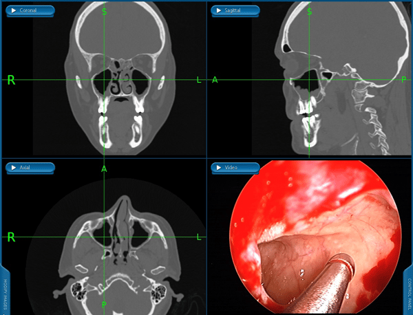 septoplastia e cirurgia endoscopica nasal em  curitiba