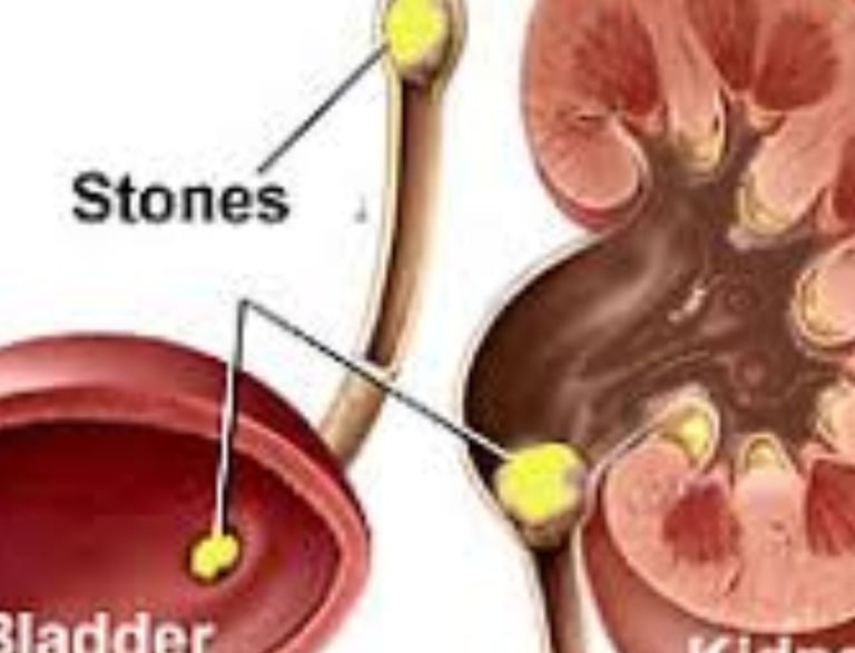 Kidney stonesimpacted ureter stonesbladder stones