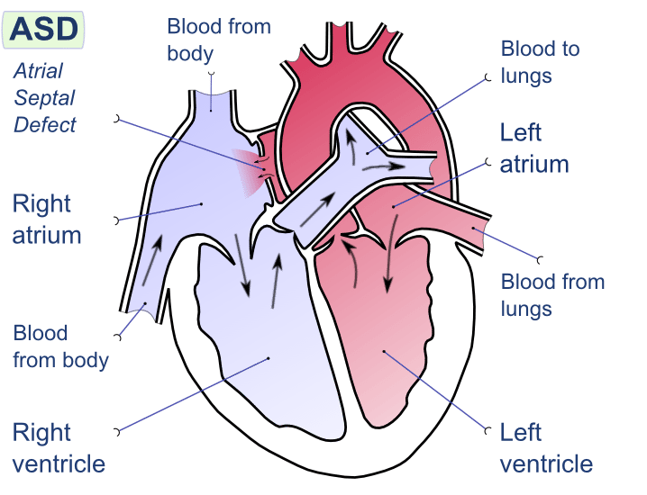 Arterial Septal Defect
