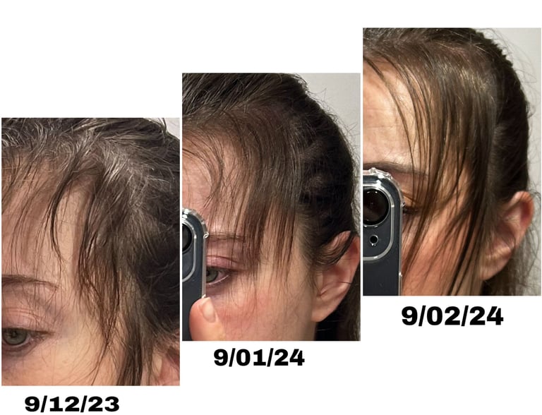 Crecimiento de cabello en las entradas de una mujer