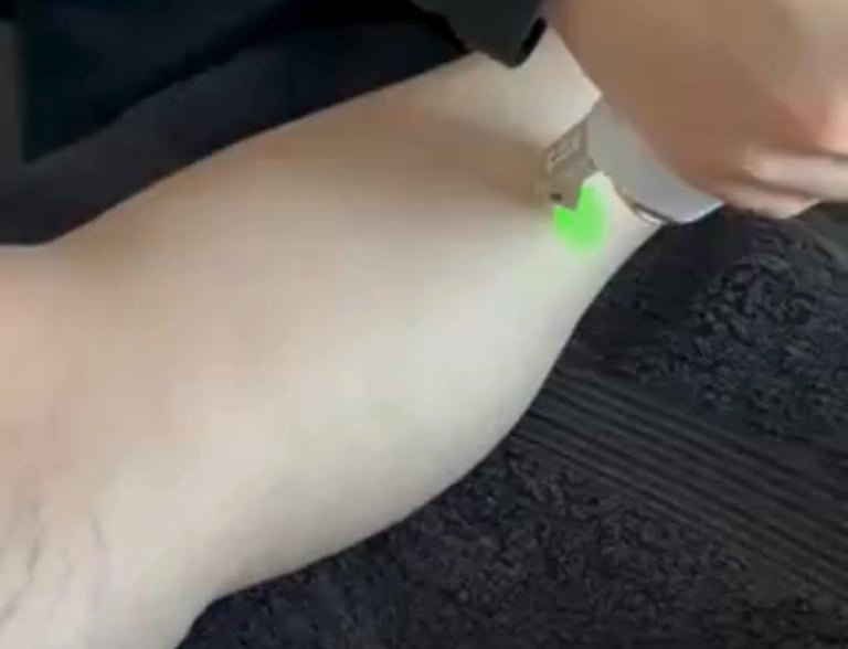 machine épilation laser jambes