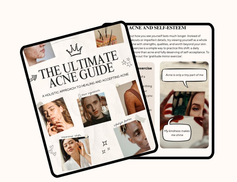 Digital guide titled 'The Ultimate Acne Guide: A holistic approach to healing and accepting acne'.