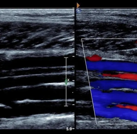 vascular ultrasound blood clot deep vein thrombosis leg swelling thinner anticoagulant embolism pain doppler factor v leiden