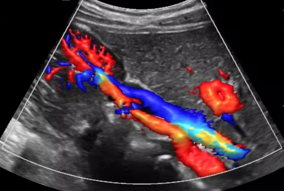 vascular ultrasound renal artery stenosis high blood pressure stent kidney disease function diabetes fibromuscular dysplasia 
