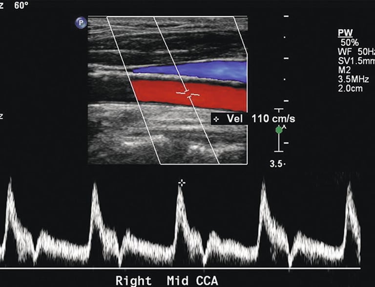 vascular ultrasound corewave perth imaging best vein artery treatment symptom scan doppler bulk bill doctor recommend near me