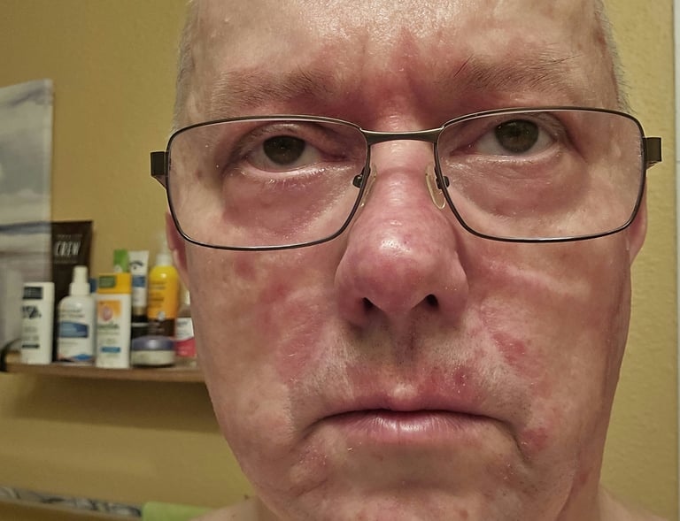 facial psoriasis systemic