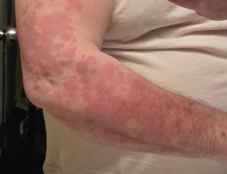 arm psoriasis systemic