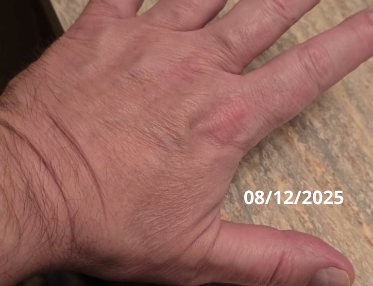 hand psoriasis healed