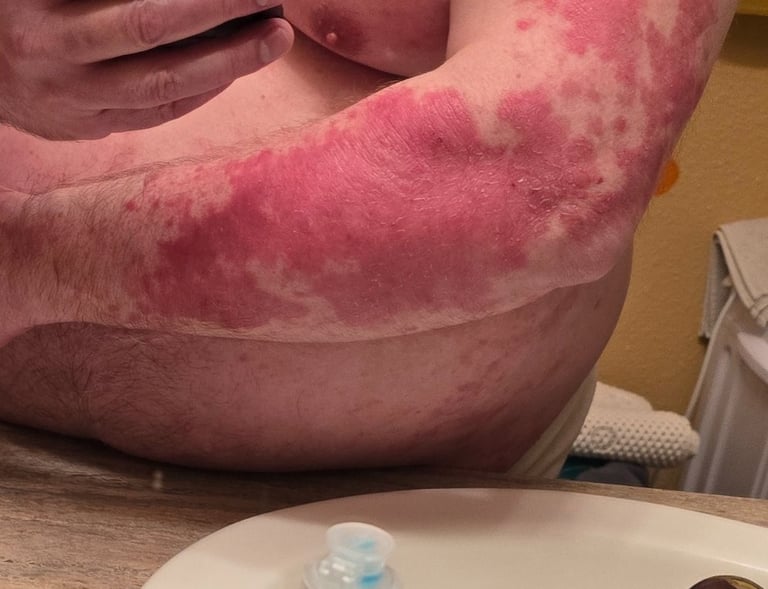 plaque psoriasis right arm