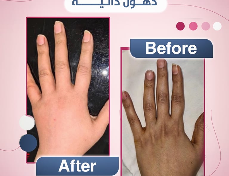 حقن الدهون الذاتية لليدين مع استشاري جراحة التجميل الدكتور ابراهيم العبد