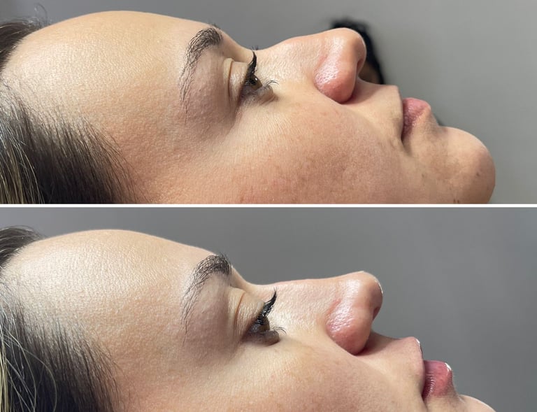 a woman with a nose job on her nose and nose