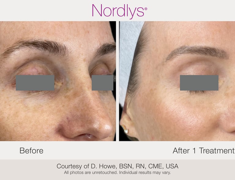 before and after skin texture improvement and rejuvenation results in Hamilton Ontario