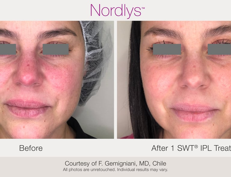 improved skin health and glowing complexion after professional treatment in Hamilton clinic