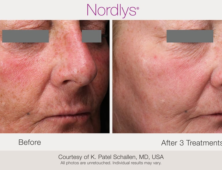 before and after rosacea and redness reduction treatment results in Hamilton clinic