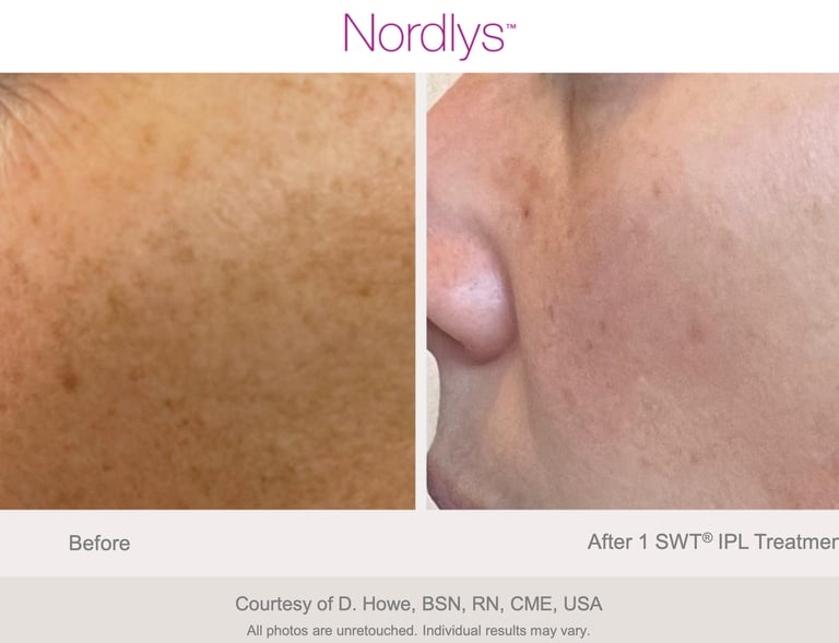 before and after stretch mark and skin texture improvement results in Hamilton clinic