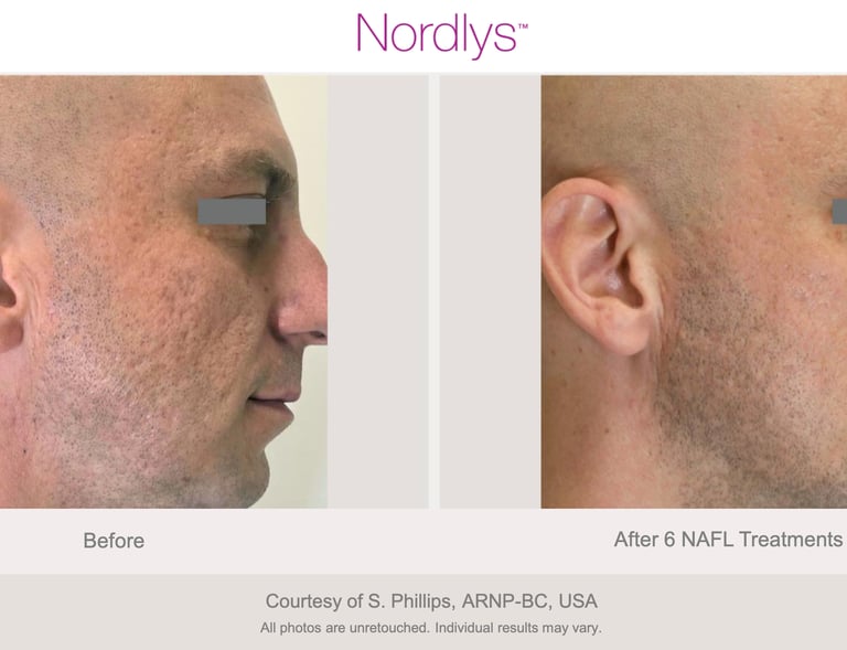 before and after acne scar improvement results at Hamilton skincare clinic