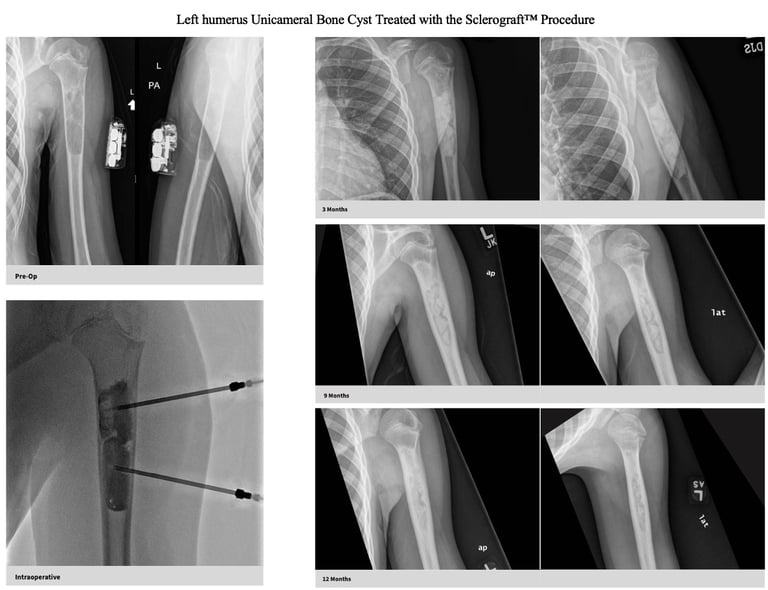 xray-unicameral-bone-cyst-humerus-sclerograft.jpg