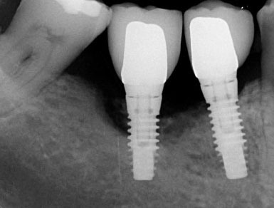 implants dentaires et hygiène jet dentaire ozone Aquolab hygiene-precision