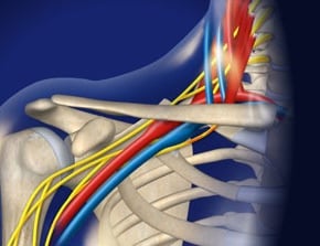 vascular ultrasound thoracic outlet syndrome arm pain cold white hand numbness tingling compression rib blood clot vein nerve