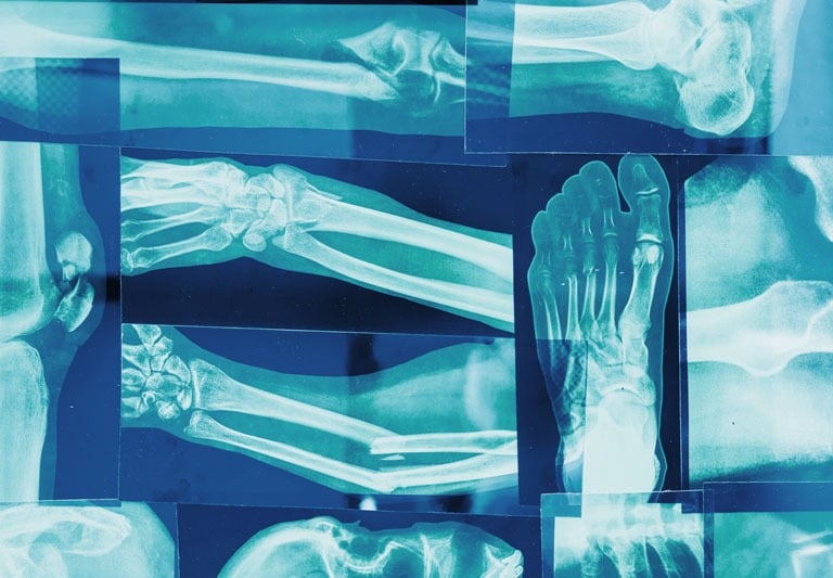 multiple overlapping blue x-rays of feet, legs, and arms