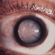 cataract effected eye lens