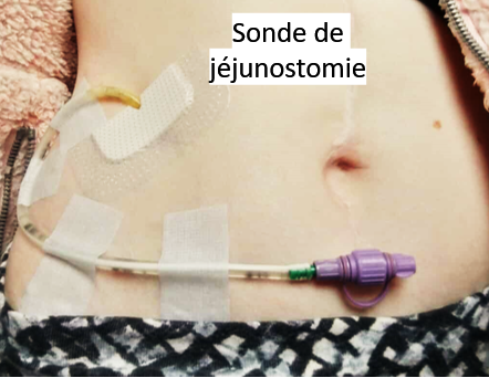 jéjunostomie