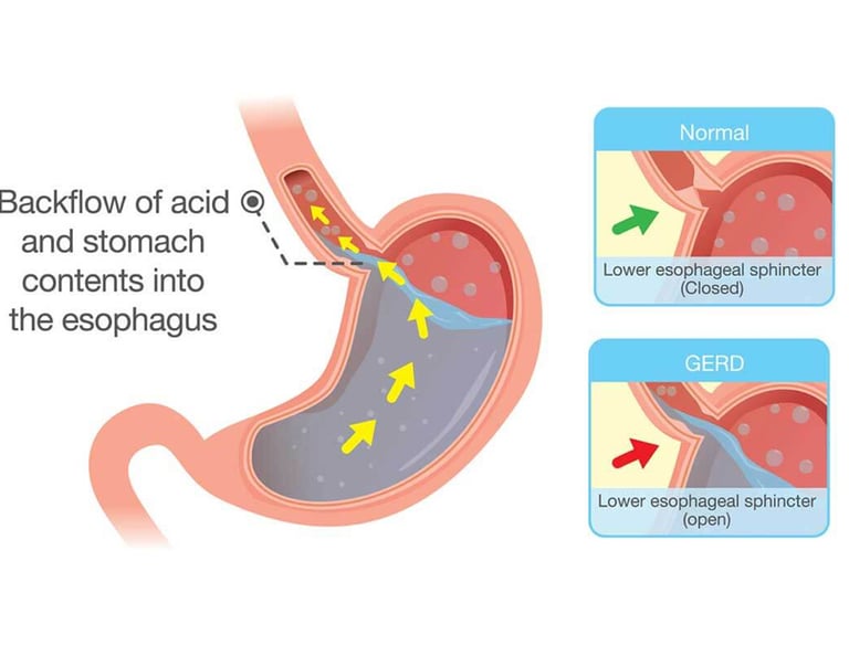 illustration of back flow of acid