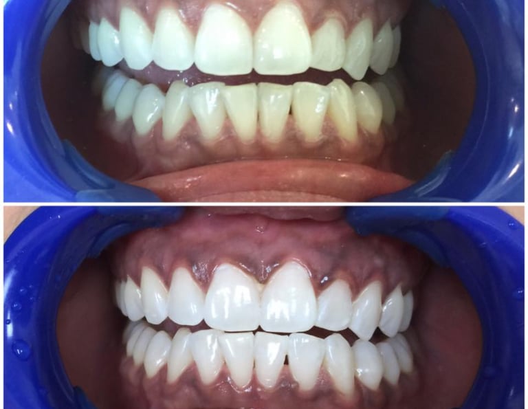 a close up of a smile with a smile on the bottom of the teeth