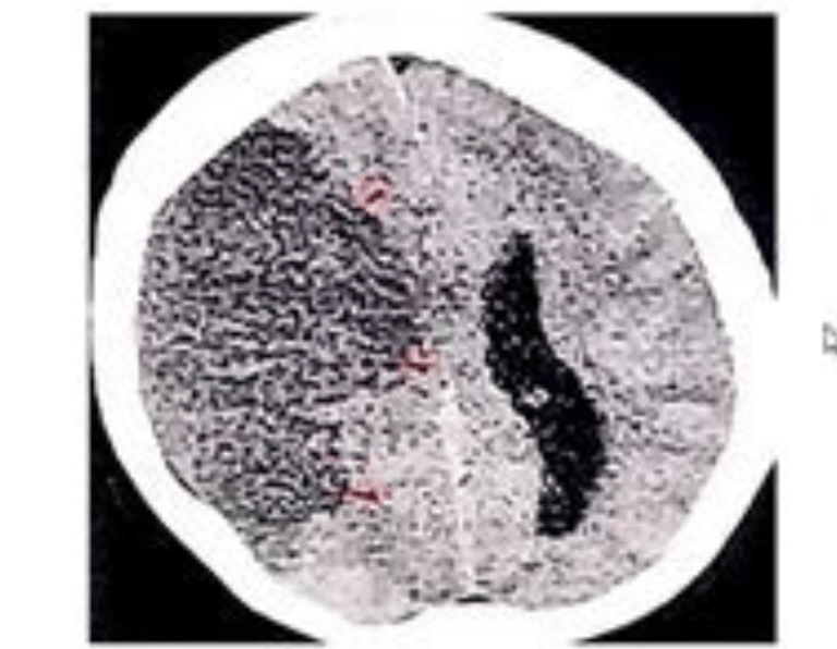 stroke ct