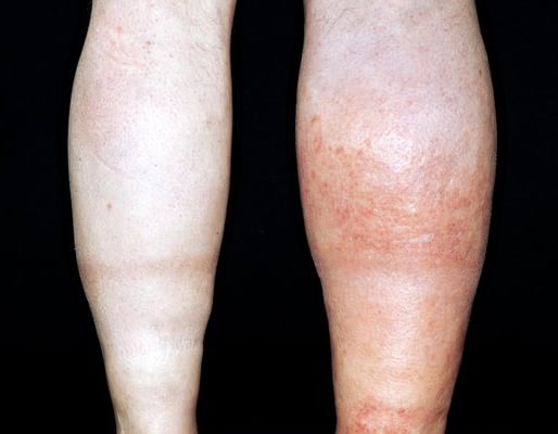 vascular ultrasound blood clot deep vein thrombosis leg swelling thinner anticoagulant embolism pain doppler factor v leiden