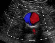 vascular ultrasound imaging perth corewave best artery vein treatment symptom scan doppler bulk bill doctor recommend near me