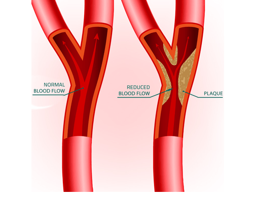 vascular ultrasound artery atherosclerosis stenosis disease stent carotid doppler stroke tia vision dizziness headache plaque