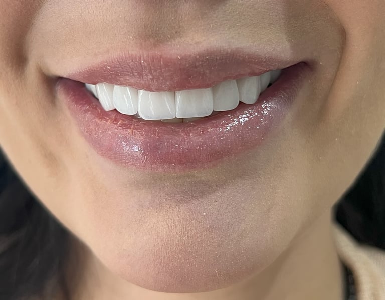 facetas de porcelana e tratamento dentario