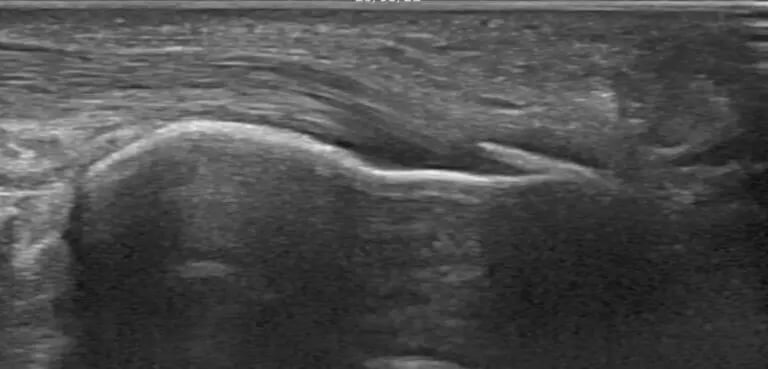 Imagen Ecográfica Calcificación en Aquiles