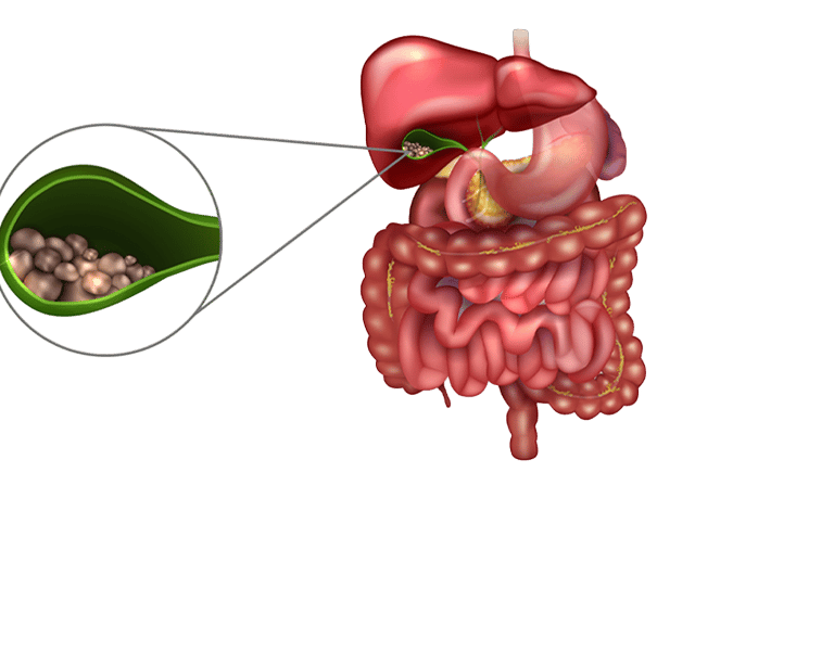Cálculos na vesícula biliar