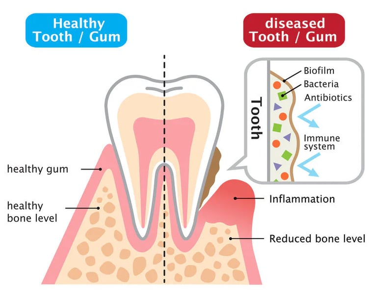 a diagram of a tooth and inflammation