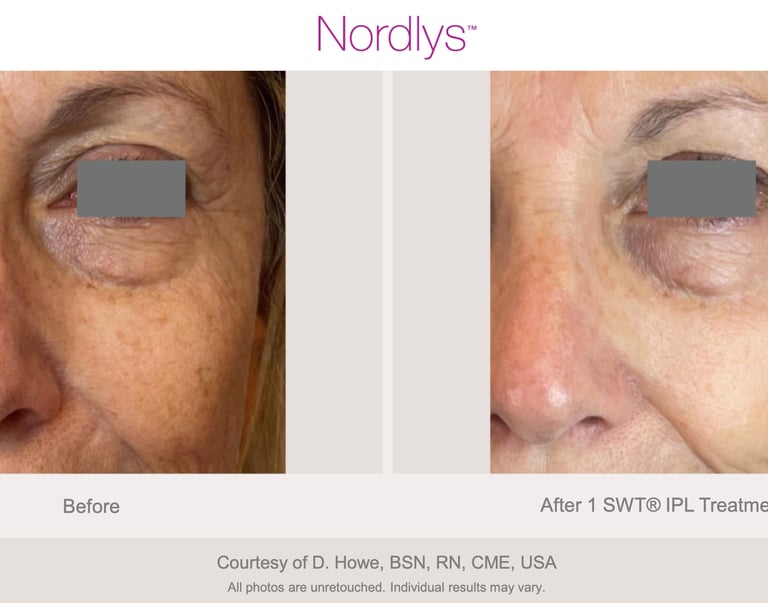professional acne treatment improving skin texture and clarity in Hamilton