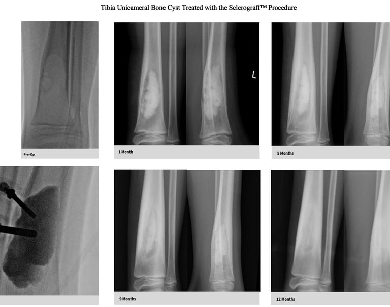 MRI-unicameral-bone-cyst-fibula-sclerograft.jpg