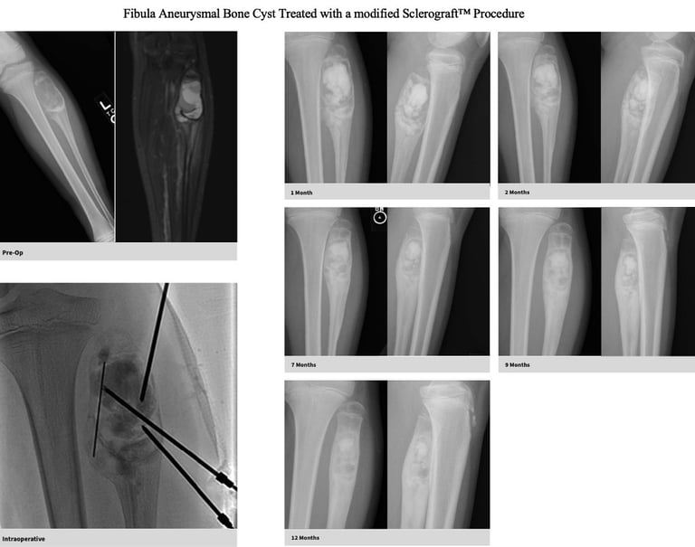 MRI-aneurysmal-bone-cyst-fibula-sclerograft.jpg