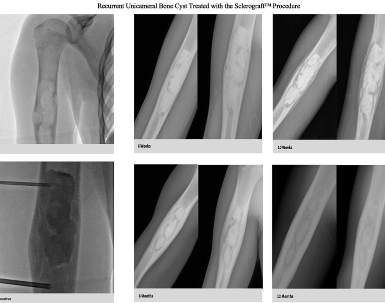 xray-unicameral-bone-cyst-humerus-recurrence-sclerograft.jpg