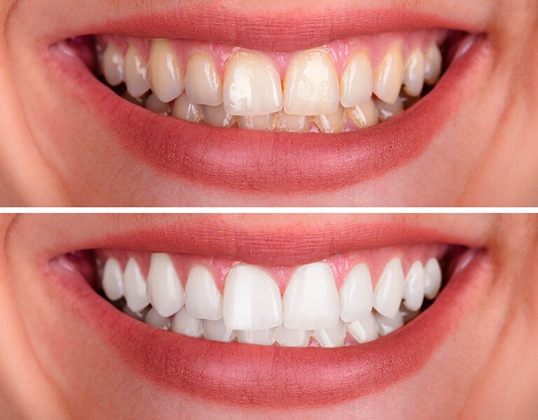 a woman's teeth whitening and teeth whitening