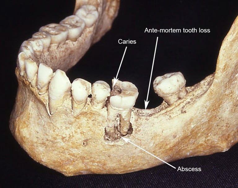 Mandible showing examples of caries, abscess and ante-mortem tooth loss