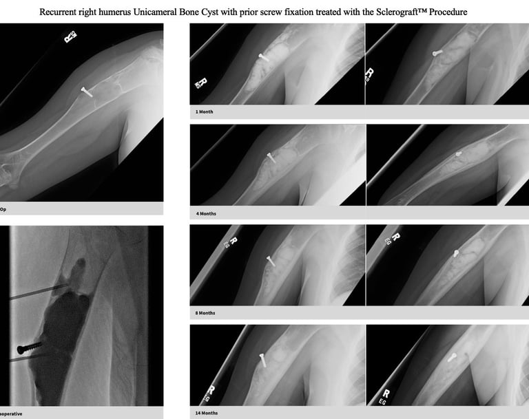 xray-unicameral-bone-cyst-humerus-prior-surgery-sclerograft.jpg