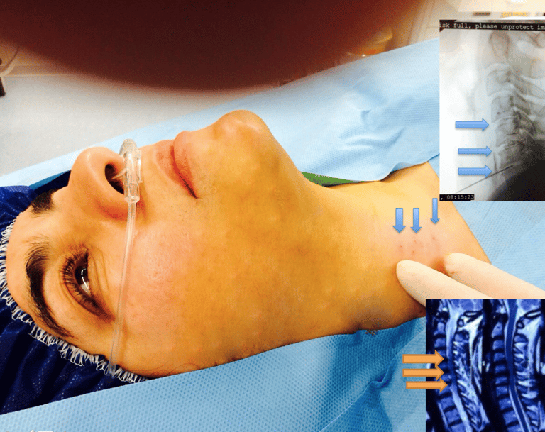 Discogel injection for 3 level Cervical herniated discs