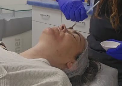 Peeling at Ariana Esthetic Edmonton