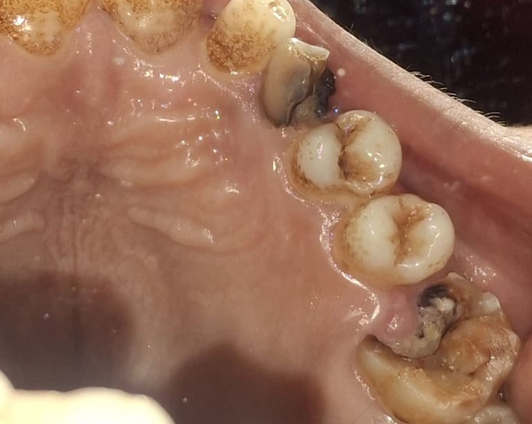 multiple carious teeth with pain loss of chewing shree dental care